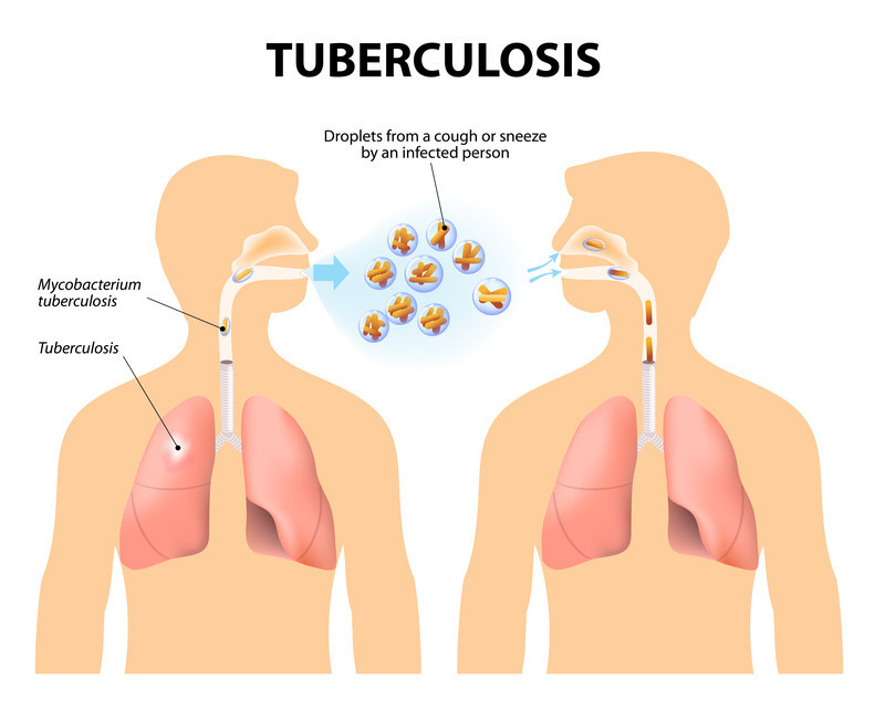 ASSE organiza jornada clave sobre Tuberculosis  con expertos de referencia en la enfermedad