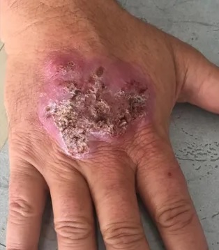 Advierten por una nueva especie de conocido hongo infeccioso que lo transmiten los gatos a los humanos