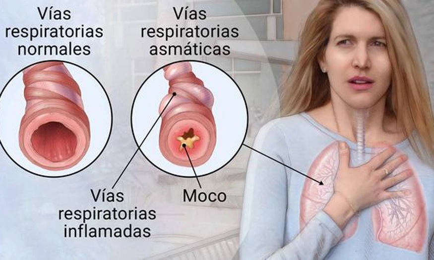 En Salto hay una alta prevalencia  de asma que mejora con tratamiento