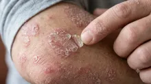Psoriasis: afecta a un 3% de la  población y el estrés la agrava