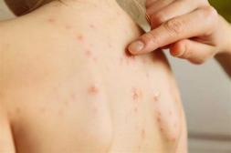 Casos de varicela se duplicaron:  de 450 en 2024 a 881 el año 2025