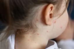 Los casos de varicela registrados  en 2026 son 65% más que 2025