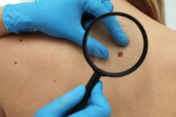 Cáncer de piel: 3.000 casos al año, las señales de alerta y la importancia de controlar los lunares al menos una vez al año