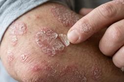 Psoriasis: afecta a un 3% de la  población y el estrés la agrava
