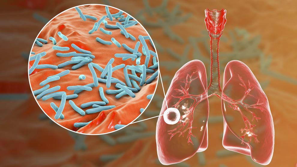 Tuberculosis: enfermedad que sigue latente y en Salto afecta a más de 30 personas