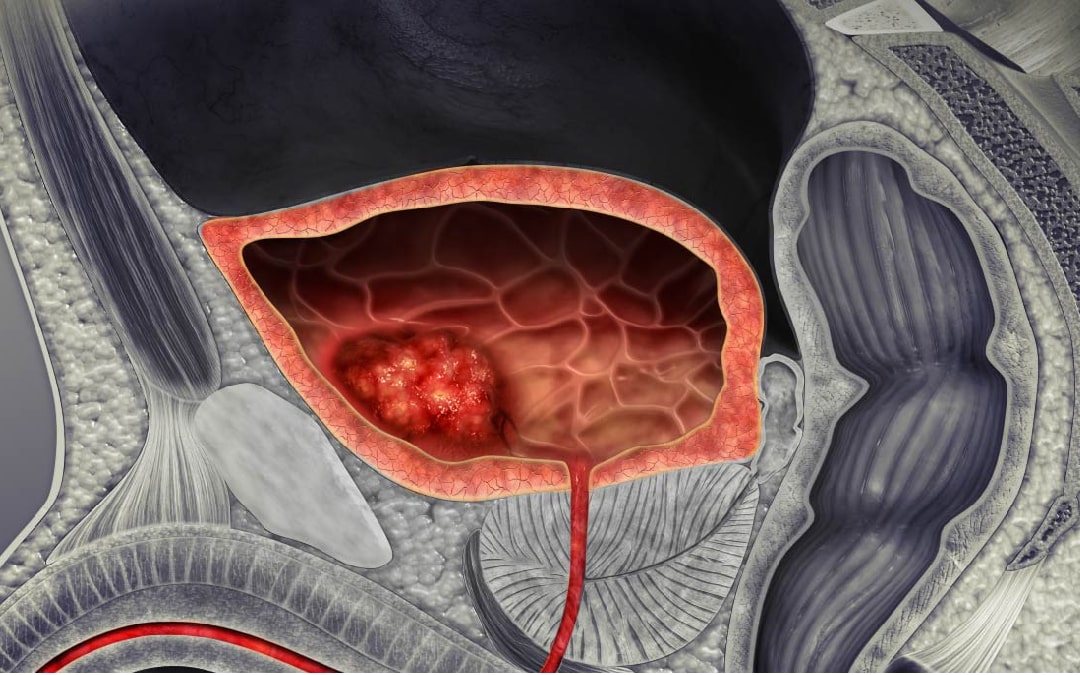 Investigadores uruguayos avanzan en estudio sobre avance del cáncer de vejiga