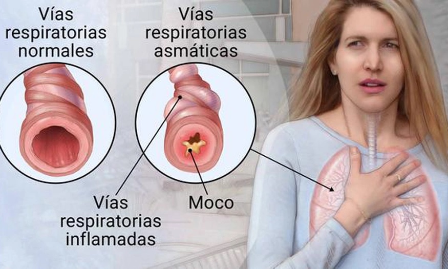 El asma afecta a un 10 % de  los niños y mejora prevención