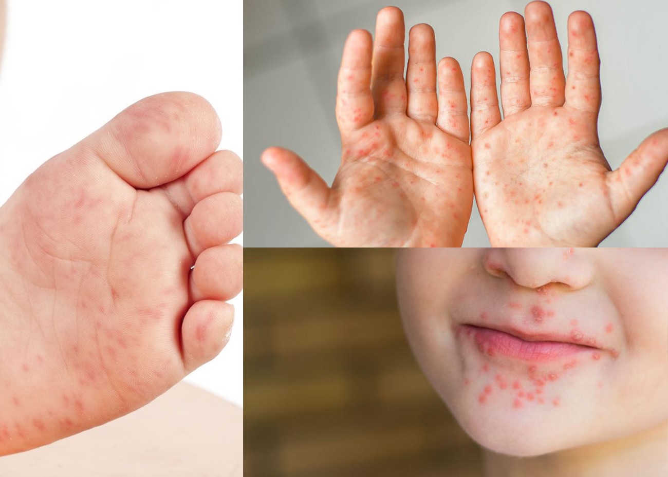 Aumentan cuadros por virus “manos-pies-boca” en niños
